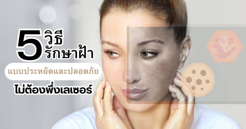 5 วิธีรักษาฝ้าแบบประหยัดและปลอดภัย ไม่ต้องพึ่งเลเซอร์