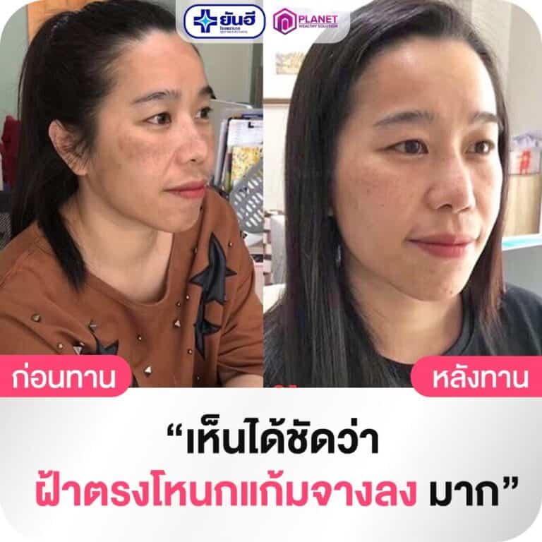 LINE ALBUM รีวิว กลูต้า อัลฟ่า เอ็กซ์ 231117 23