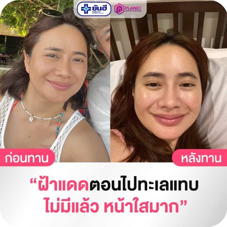 LINE ALBUM รีวิว กลูต้า อัลฟ่า เอ็กซ์ 231117 24