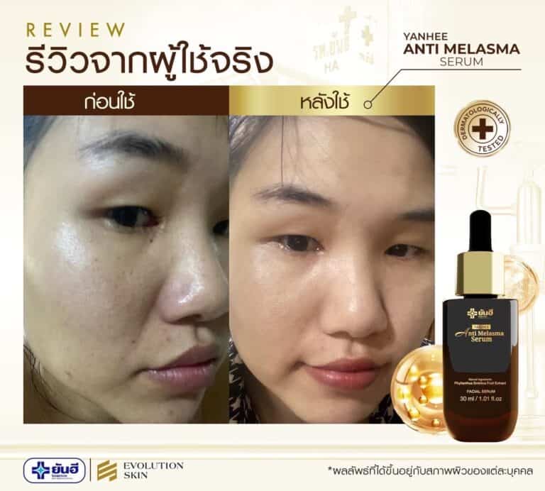 LINE ALBUM รีวิว แอนตี้ มาลาสม่า 231123 4