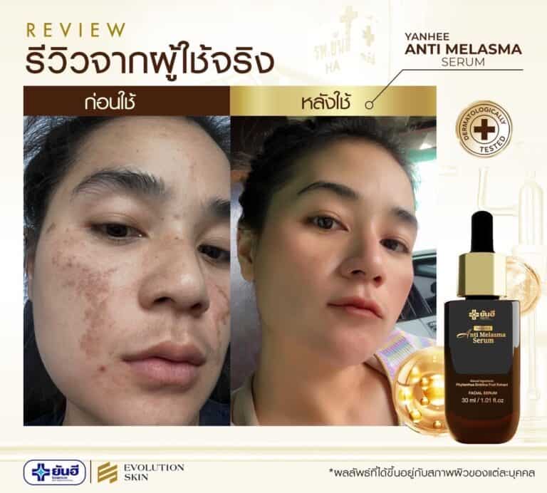 LINE ALBUM รีวิว แอนตี้ มาลาสม่า 231123 6
