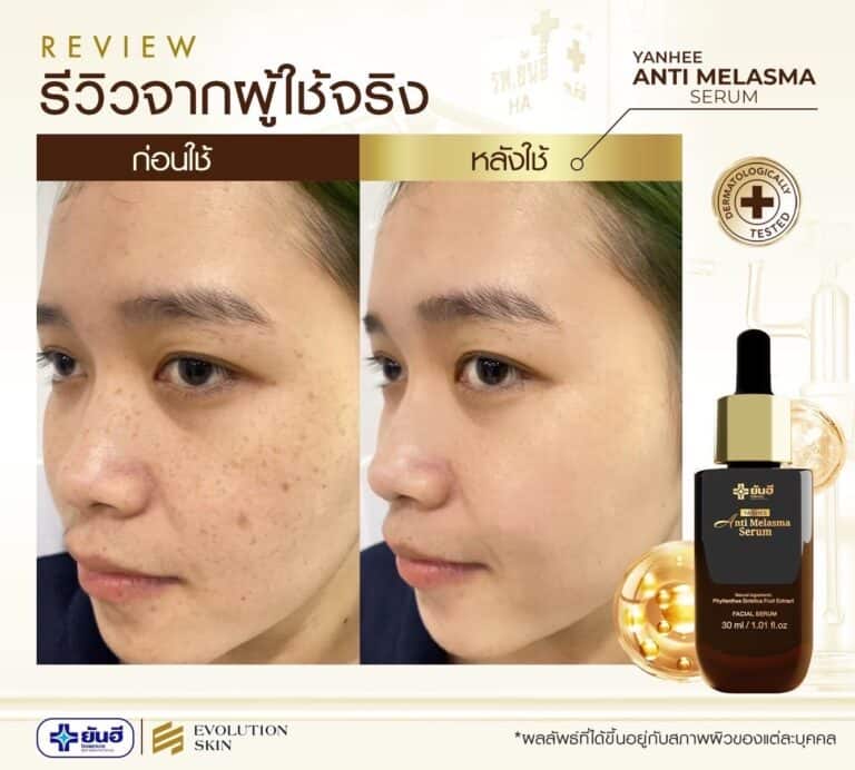 LINE ALBUM รีวิว แอนตี้ มาลาสม่า 231123 7