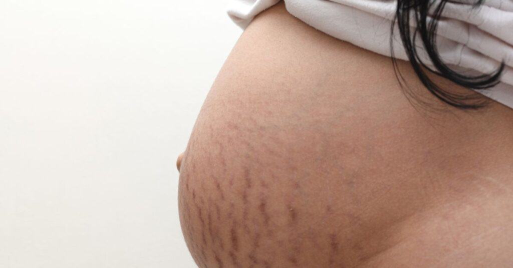 ผิวแตกลายเกิดจากอะไร 5 สาเหตุหลักที่คุณอาจไม่เคยรู้