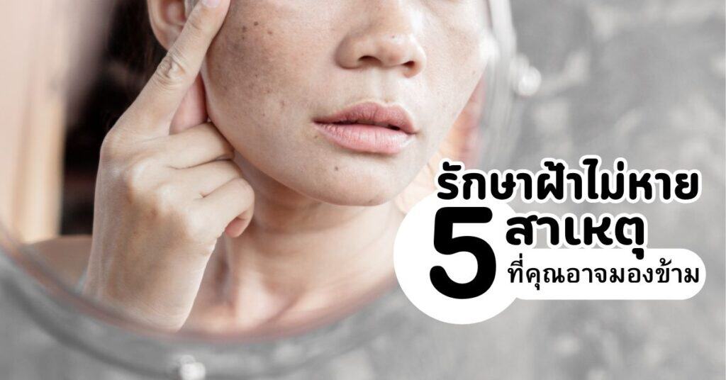 รักษาฝ้าไม่หาย ค้นพบ 5 สาเหตุที่คุณอาจมองข้าม 21 รักษาฝ้าไม่หาย 5 สาเหตุที่คุณอาจมองข้าม