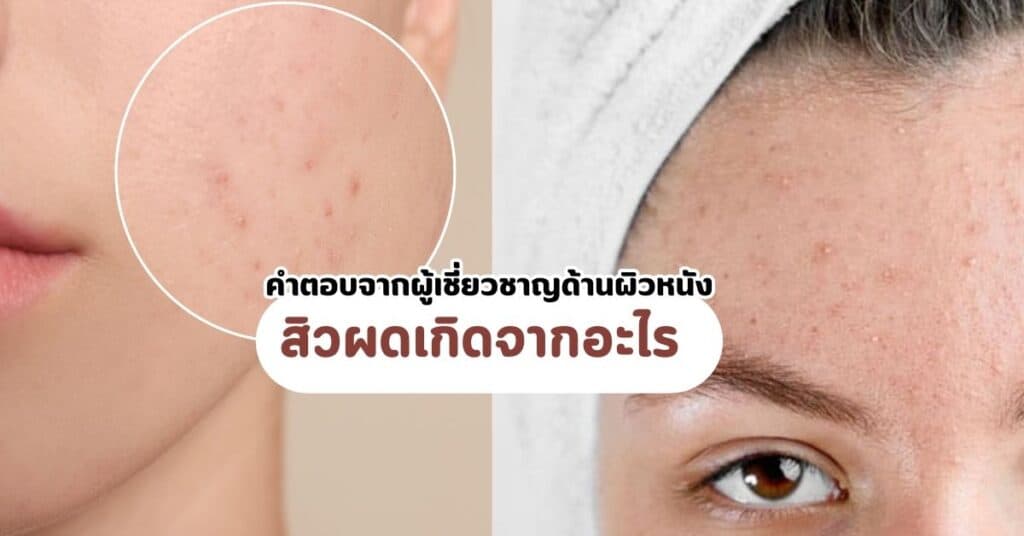 สิวผดเกิดจากอะไร วิธีรักษาแบบเร่งด่วน และคำตอบจากผู้เชี่ยวชาญด้านผิวหนัง 7 สิวผดเกิดจากอะไร-คำตอบจากผู้เชี่ยวชาญด้านผิวหนัง