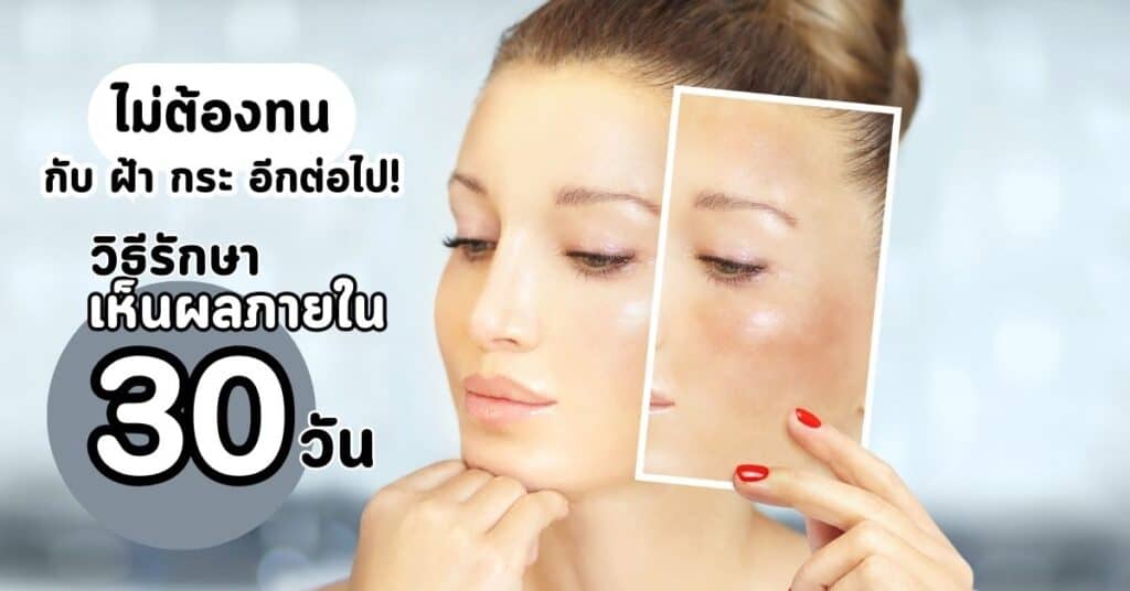 ไม่ต้องทนกับ ฝ้า กระ อีกต่อไป! ค้นพบวิธีรักษาเห็นผลภายใน 30 วัน 2 ไม่ตัองทนกับฝ้า กระ อีกต่อไป วิธีรักษา เห็นผลภายใน 30 วัน