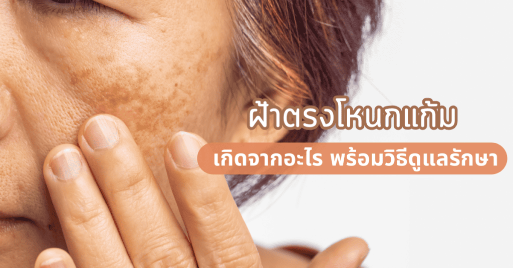 ฝ้าตรงโหนกแก้ม เกิดจากอะไร พร้อมวิธีดูแลรักษา 2 ฝ้าตรงโหนกแก้ม