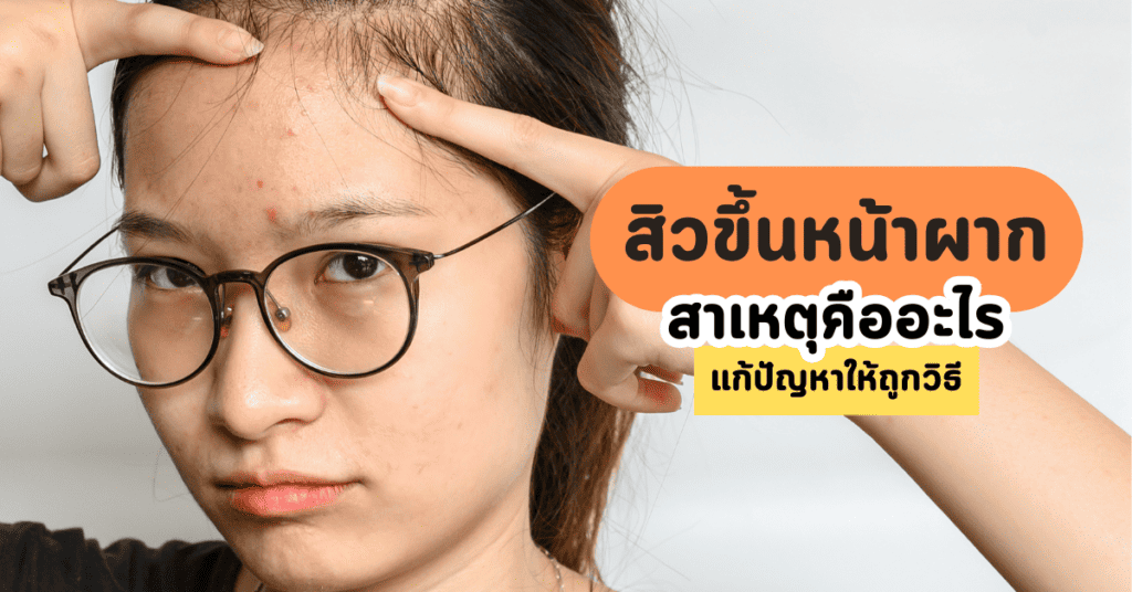 สิวขึ้นหน้าผาก สาเหตุคืออะไร แก้ปัญหาให้ถูกวิธี 30 สิวขึ้นหน้าผาก