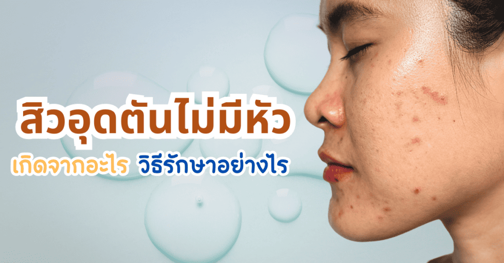 สิวอุดตันไม่มีหัว เกิดจากอะไร วิธีรักษาอย่างไร 18 สิวอุดตันไม่มีหัว