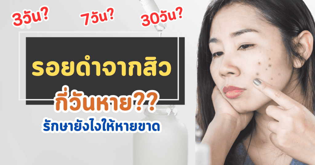 รอยดําจากสิว กี่วันหาย รักษายังไงให้หายขาด 2 รอยดําจากสิว กี่วันหาย