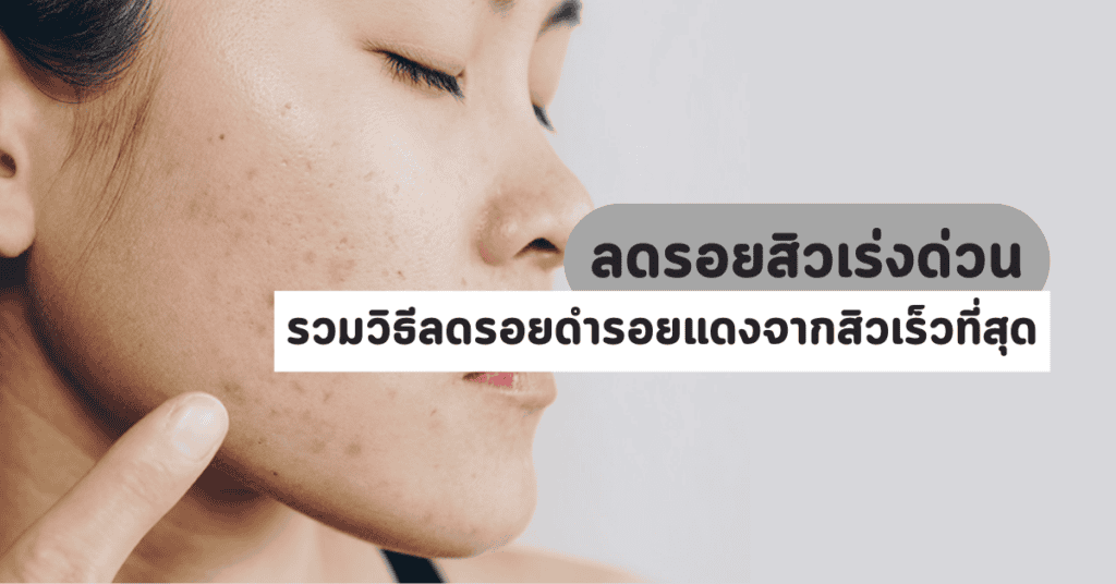 ลดรอยสิวเร่งด่วน