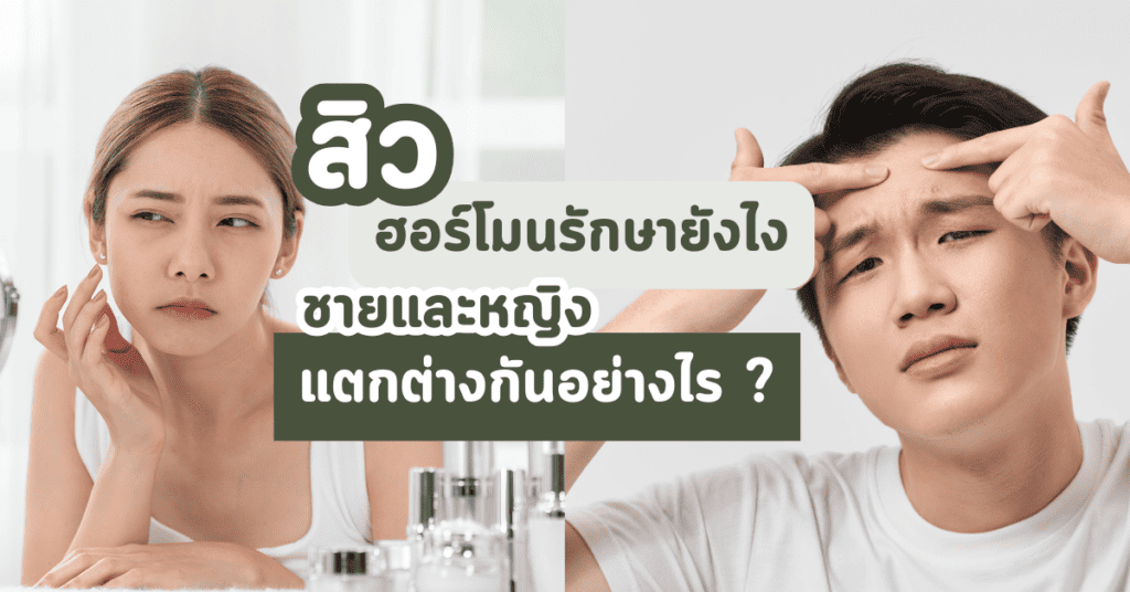 สิวฮอร์โมนรักษายังไง ชายและหญิงแตกต่างกันอย่างไร 6 สิวฮอร์โมนรักษายังไง