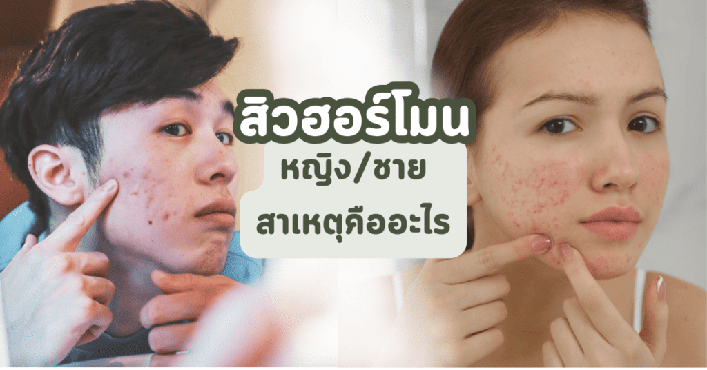 สิวฮอร์โมนรักษายังไง ชายและหญิงแตกต่างกันอย่างไร 3 สิวฮอร์โมนชาย สิวฮอร์โมนหญิง