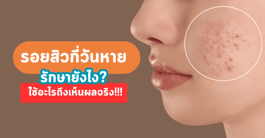 รอยสิวกี่วันหาย รักษายังไง ใช้อะไรถึงเห็นผลจริง 2 รอยสิวกี่วันหาย