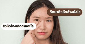 สิวหัวช้างเกิดจากอะไร รักษาสิวหัวช้างยังไง มีคำตอบ