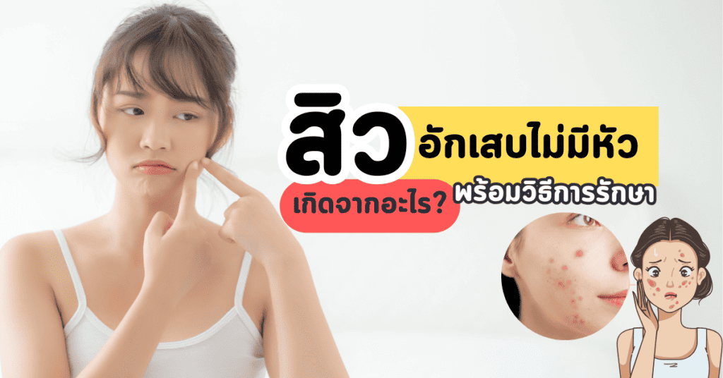 สิวอักเสบไม่มีหัว เกิดจากอะไร พร้อมวิธีการรักษา 8 สิวอักเสบไม่มีหัว