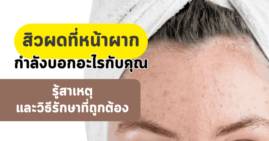 สิวผดที่หน้าผาก กำลังบอกอะไรกับคุณ รู้สาเหตุ และวิธีรักษาที่ถูกต้อง 12 สิวผดที่หน้าผาก กำลังบอกอะไรกับคุณ รู้สาเหตุ และวิธีรักษาที่ถูกต้อง