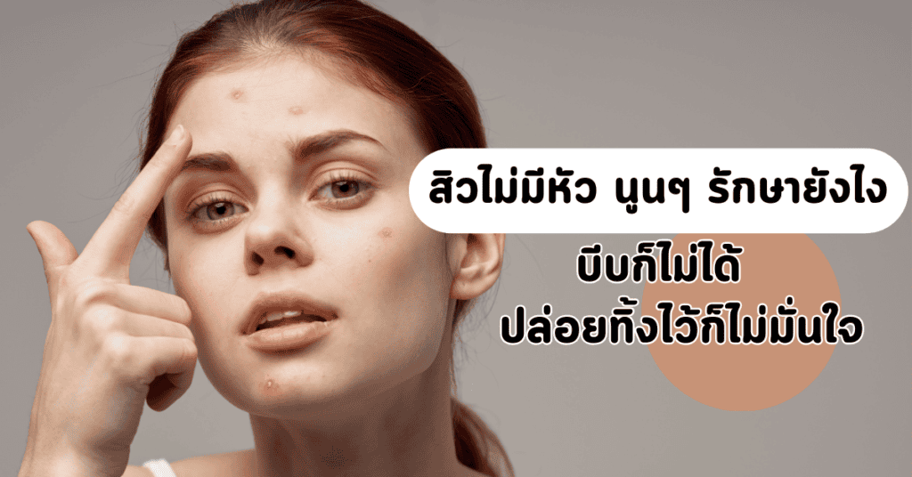 สิวไม่มีหัว นูนๆ รักษายังไง